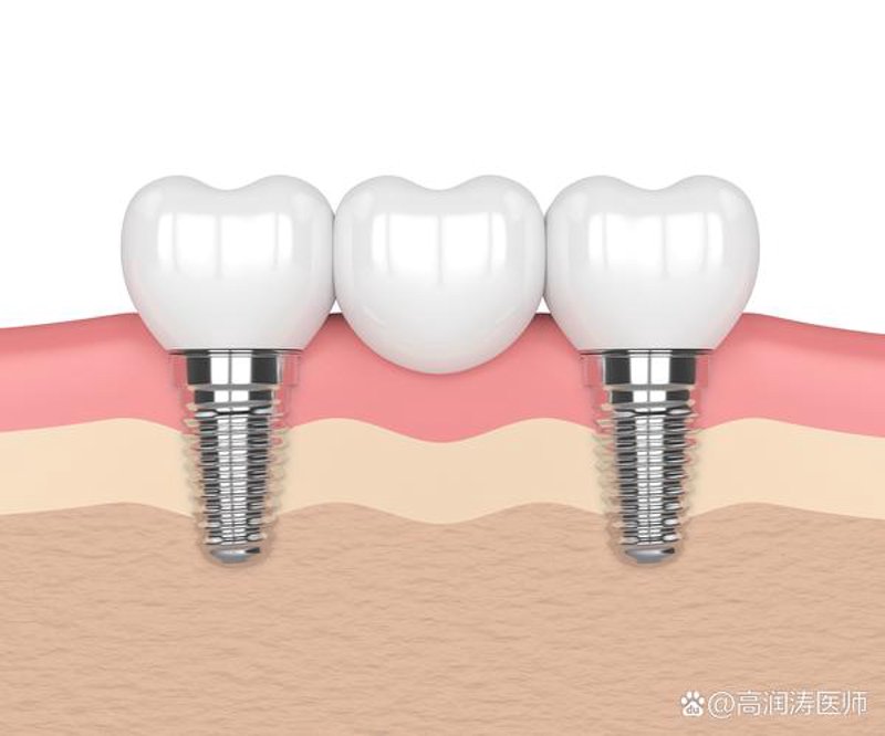 牙齿矫正新趋势：传统与隐形的碰撞