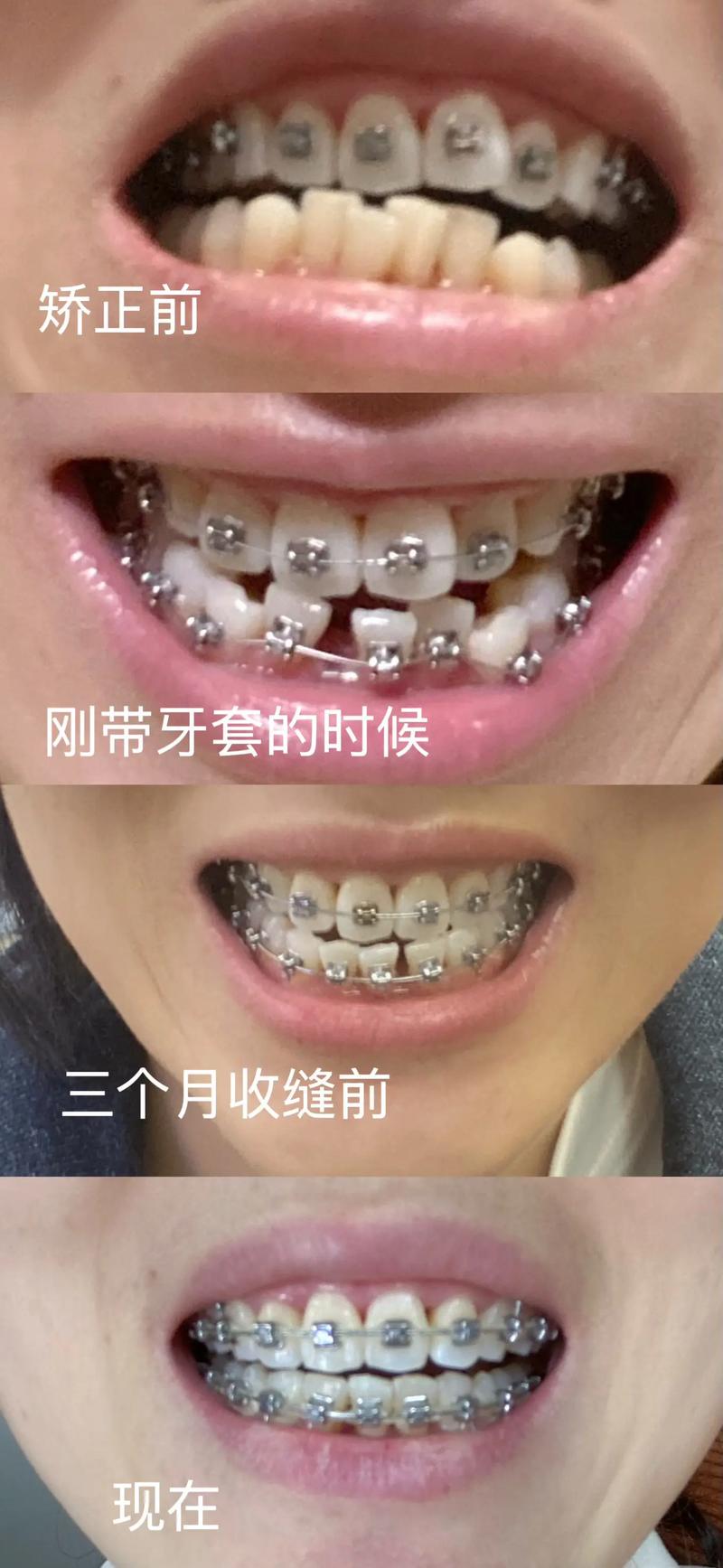 牙齿种植：科技与健康的双重绽放